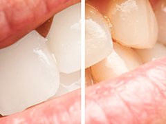 歯の黄ばみが気になる方には「ホワイトニング」