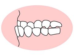 反対咬合（はんたいこうごう）